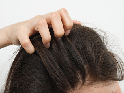 Leiden Sie unter Schuppenflechte auf Ihrer Kopfhaut? Entdecken Sie die Ursachen und Lösungen