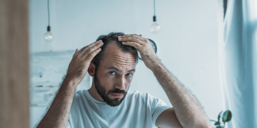 Die Norwood-Skala: Ein Leitfaden für männliche Glatzenbildung