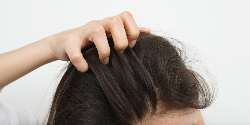 Leiden Sie unter Schuppenflechte auf Ihrer Kopfhaut? Entdecken Sie die Ursachen und Lösungen